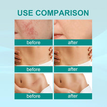 Load image into Gallery viewer, Advanced Scar Spray For All Types of Scars - For example Acne Scars, Surgical Scars and Stretch Marks