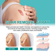 Load image into Gallery viewer, Advanced Scar Spray For All Types of Scars - For example Acne Scars, Surgical Scars and Stretch Marks