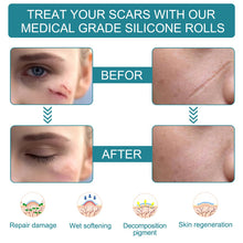 Load image into Gallery viewer, Medical Soft Silicone Gel Tape for Scar Removal